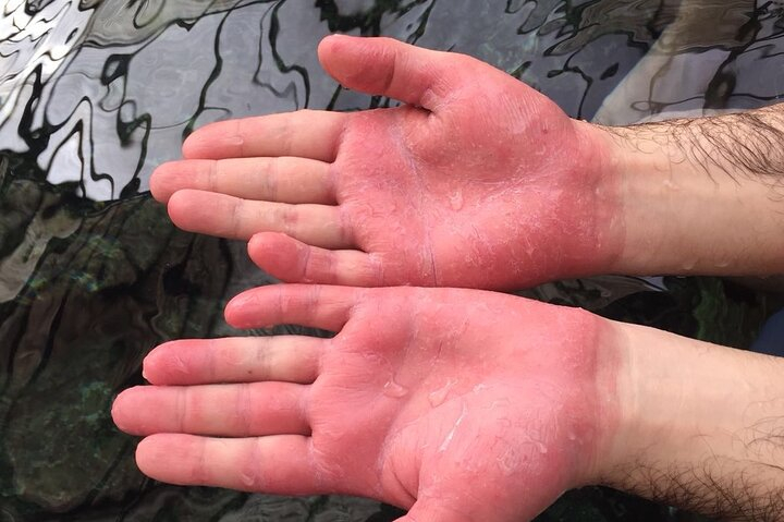 Psoriasis Fish Treatment by Garra Rufa Dr Fish in Turkey for 21 Days tr3OnzLM